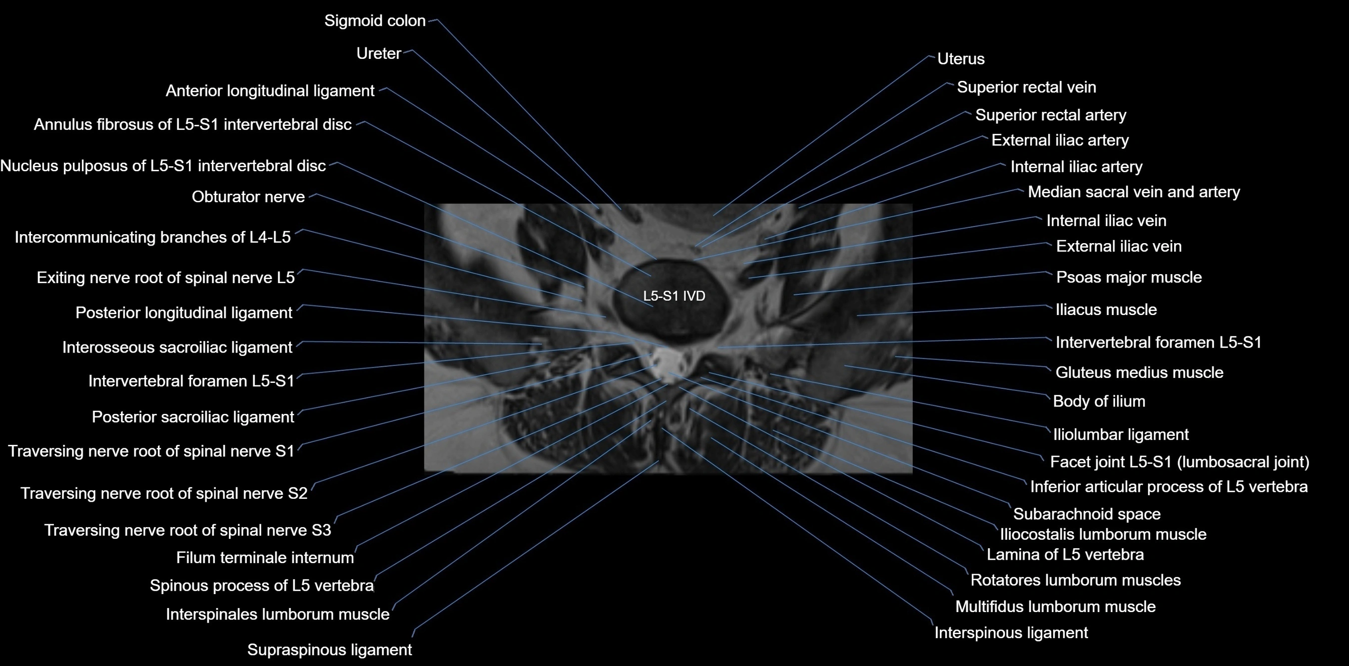 MRI sacrum, coccyx and sacroiliac joint axial cross sectional anatomy 3T  radiology  image-img-00001-00006.webp